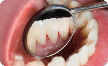 What is Periodontal Disease?