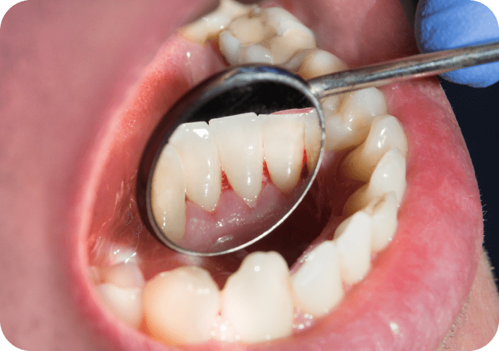   What is Periodontitis?
