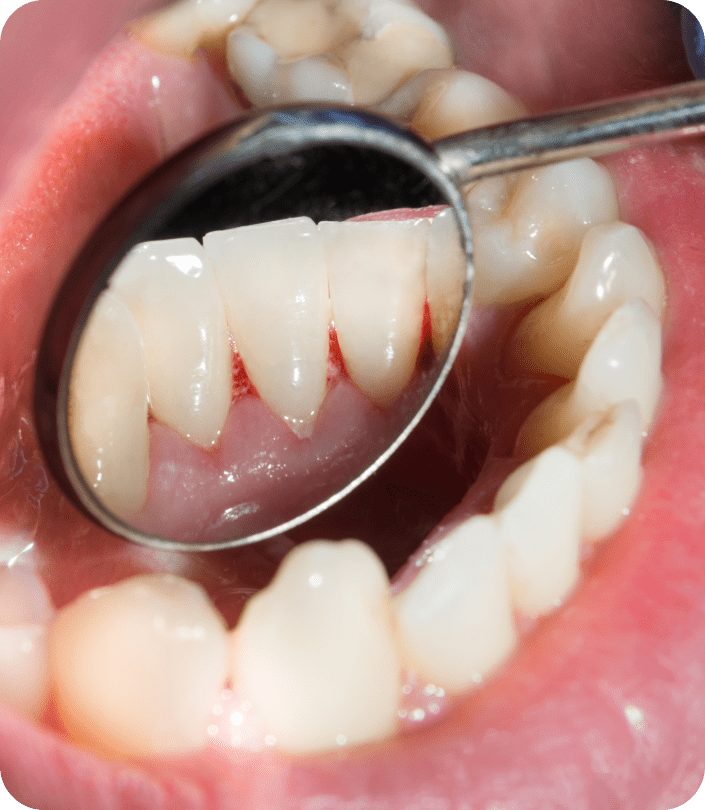 What is Periodontal Disease?